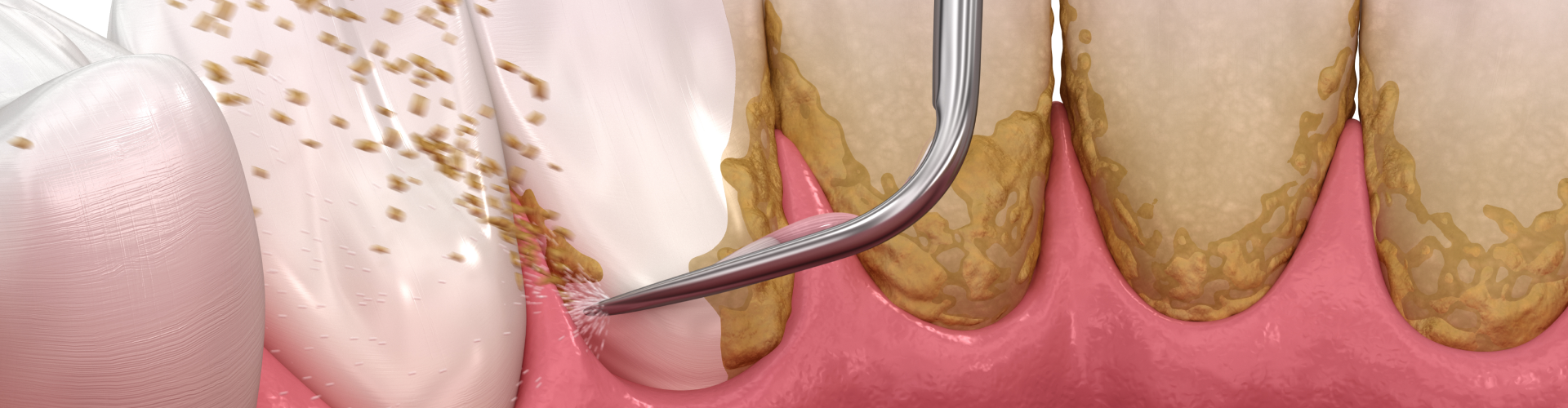 dental scraper removing buildup from back of teeth